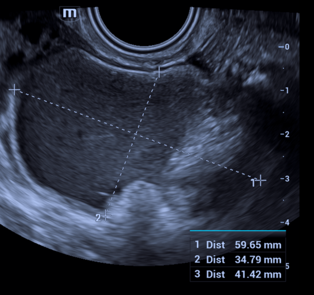Ilustração: Cisto dermoide típico < 10 cm